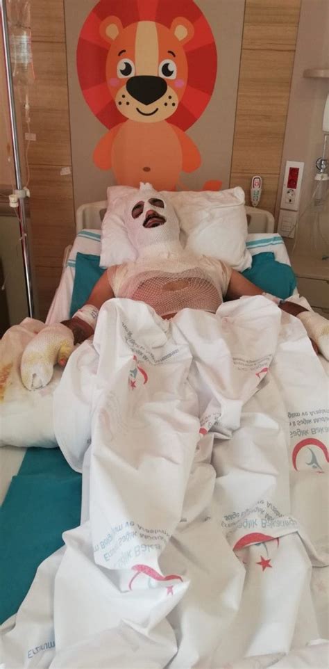 E­r­z­i­n­c­a­n­­d­a­ ­t­i­n­e­r­ ­i­l­e­ ­a­t­e­ş­ ­y­a­k­m­a­k­ ­i­s­t­e­y­e­n­ ­g­e­n­c­i­n­ ­y­ü­z­ü­ ­y­a­n­d­ı­